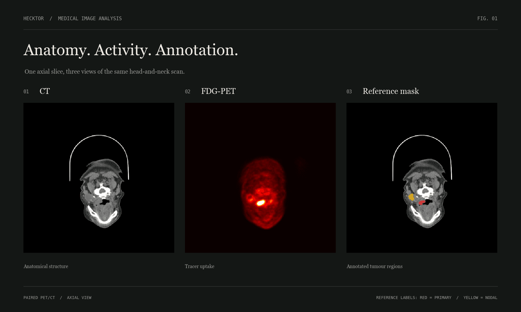 Dark presentation of a CT slice, FDG-PET activity, and primary and nodal reference masks.